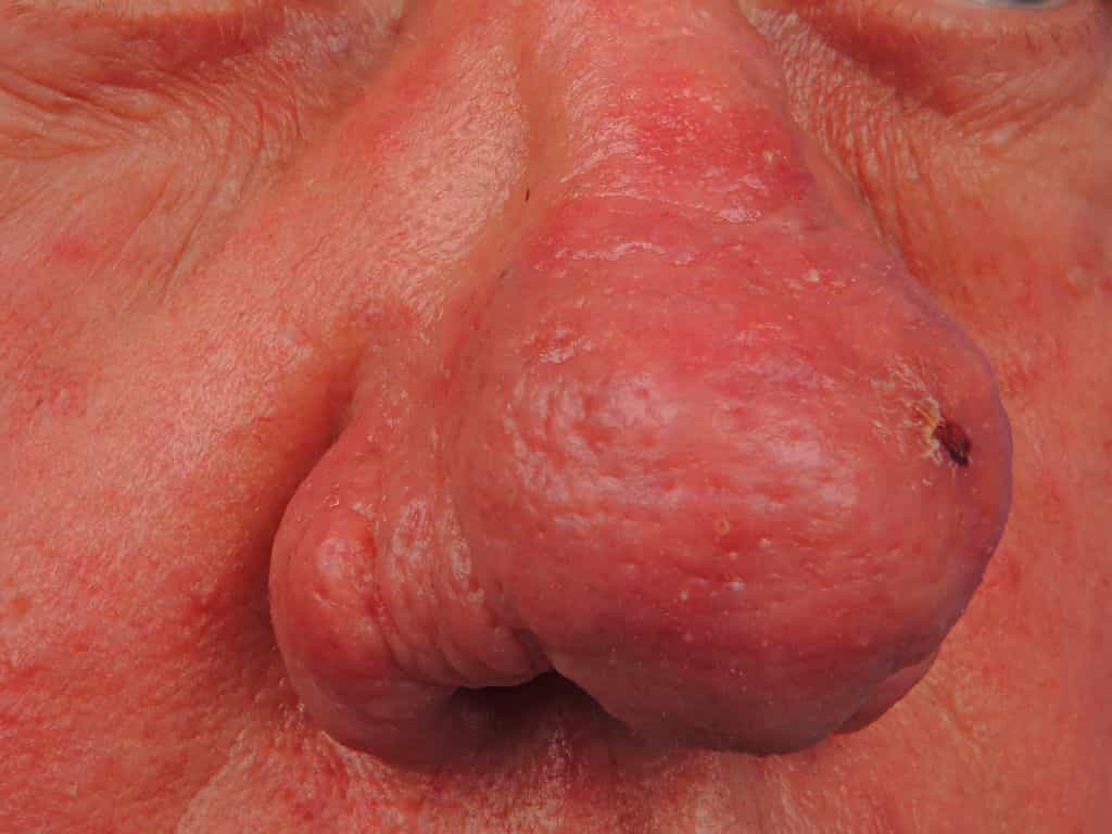 acne rosacea naso