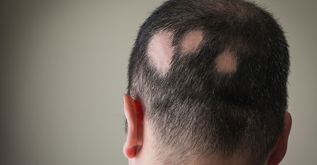 Alopecia areata