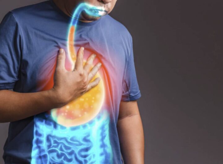 Le alte temperature, insieme a modifiche nelle abitudini alimentari tipiche della stagione estiva, contribuiscono a intensificare i sintomi