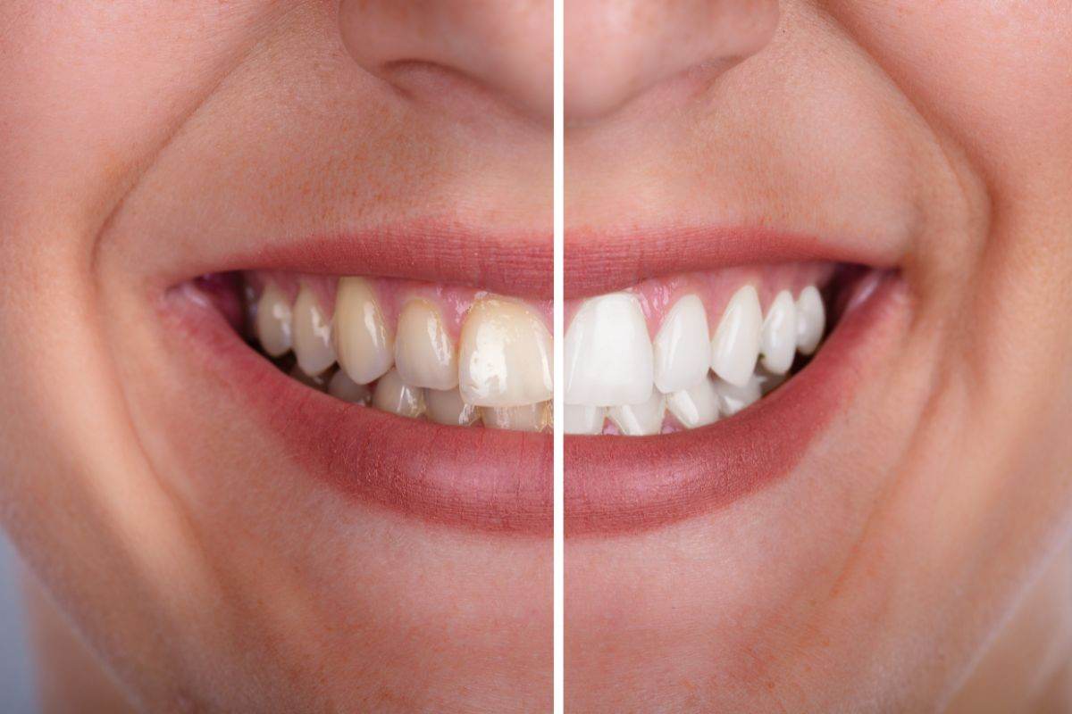 usa questi prodotti per sbiancare i tuoi denti in soli 3 minuti